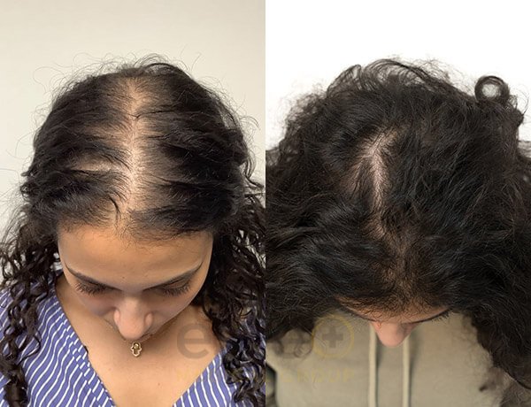 Hair Replacement Result